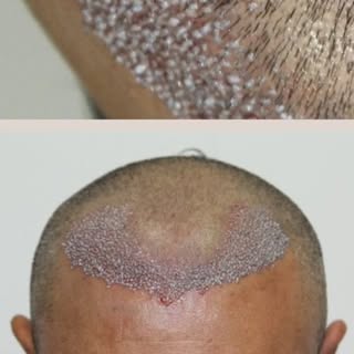 1 year of Hair Transplant result