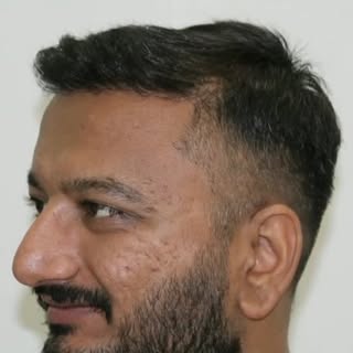 100% natural result of hair transplantation 

📞For  more information call now: +91 63 55766 940

📍