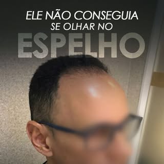Transplante capilar é um procedimento que necessita, obrigatoriamente, de obediência aos rigores leg