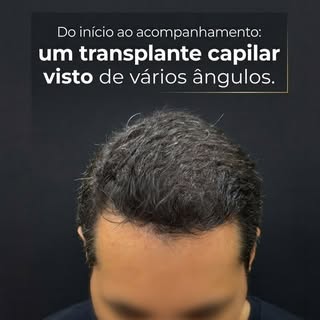 Transplante capilar é um procedimento que necessita, obrigatoriamente, de obediência aos rigores leg