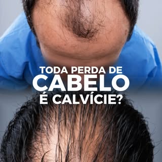 Transplante capilar é um procedimento que necessita, obrigatoriamente, de obediência aos rigores leg