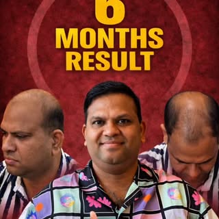 From severe Grade 7 baldness to visible transformation—this is what the right expertise can achieve!