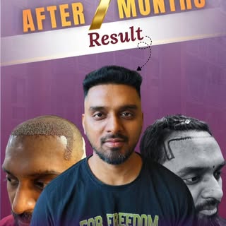 Wait… this is just 7 months of transformation!

From visible hair loss to fuller, natural-looking ha