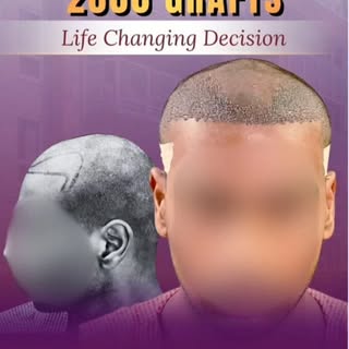 Hair loss can affect confidence at any age. In this case, our patient with Grade 2 baldness underwen
