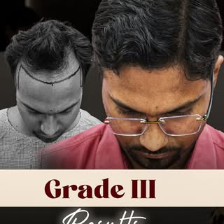 Dr. Sudhir’s Trust, Our Results!
At 32, Dr. Sudhir began experiencing hair loss, which deeply impact