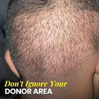 A successful hair transplant doesn't start with the hairline—it starts with proper donor area planni