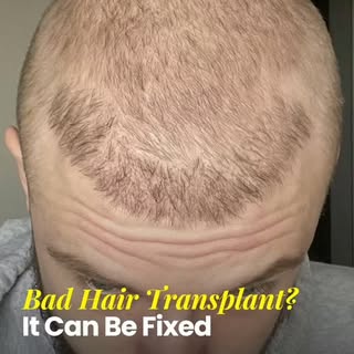 Bad Hair Transplant? It Can Be Fixed.

A failed hair transplant doesn't always mean the end of your 