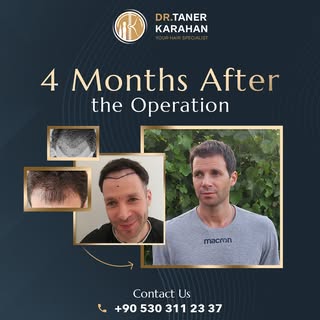 One patient a day, one perfect result!

Hair transplantation is a permanent hair loss treatment. The