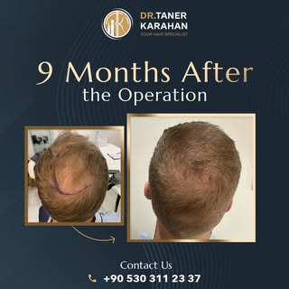 One patient a day, one perfect result!

Hair transplantation is a permanent hair loss treatment. The