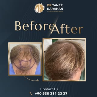 ✨ One Patient a Day, One Perfect Result! ✨

Say goodbye to hair loss and restore your confidence! Ou