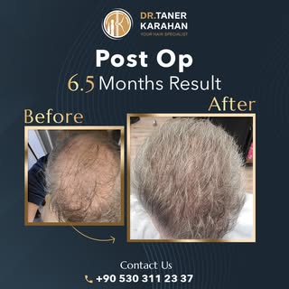 ✔️ Post op 6.5 Months Result

Hair transplantation is a permanent hair loss treatment. The hair is e