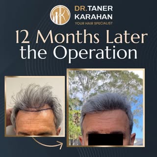 ✔️ Post op 12 Months Result

Hair transplantation is a permanent hair loss treatment. The hair is ex