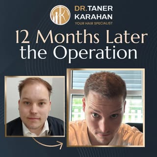 ✔️ Post op 12 Months Result

Hair transplantation is a permanent hair loss treatment. The hair is ex
