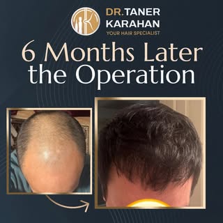 ✔️ Post op 6 Months Result

Hair transplantation is a permanent hair loss treatment. The hair is ext