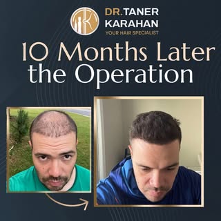 ✔️ Post op 10 Months Result

Hair transplantation is a permanent hair loss treatment. The hair is ex