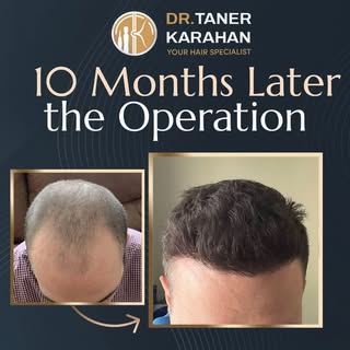 ✔️ Post op 10 Months Result

Hair transplantation is a permanent hair loss treatment. The hair is ex