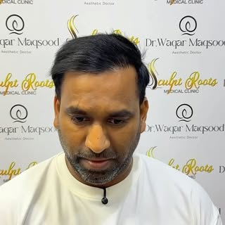 Grade IV Baldness. Eight Months. One Confident Smile.
Every successful hair restoration journey begi