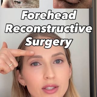 Great looking result on the forehead after Mohs surgery and reconstruction.

👩🏼‍⚕️Carolyn Hardin, 