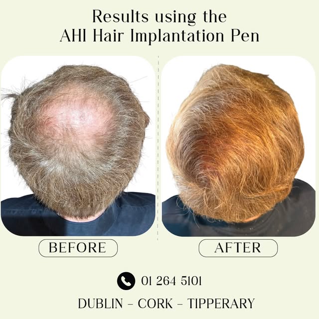 Why should you choose the Ailesbury Hair Clinics?

✅️Natural Results.

✅️Permanent solution.

✅️Tail