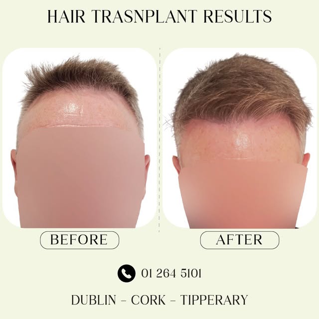 ✨ Real Results. Real Confidence. ✨

An incredible transformation by Ailesbury Hair Clinic 💪
From vi