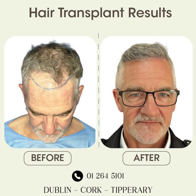 ✨ Real Results. Real Confidence. ✨

An incredible transformation by Ailesbury Hair Clinic 💪
From vi