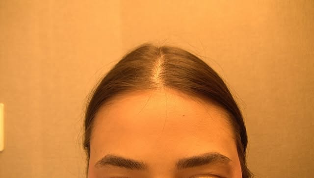 Uma prévia desse lindo  pós operatório de Transplante Capilar Feminino!

7 dias separam o antes e o 