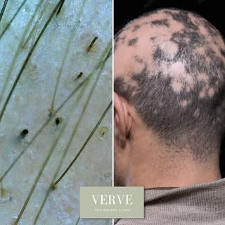 What a difference magnification can make 🔬

Magnification allows us to examine the scalp and hair i