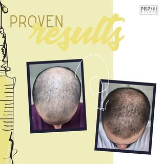 Before and After

Consistency is key. 

This is 5 sessions of PRP Therapy with microneedling. The re