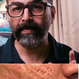 CO2 Fractional Laser for acne scars: what results can you realistically expect? In this video, I exp