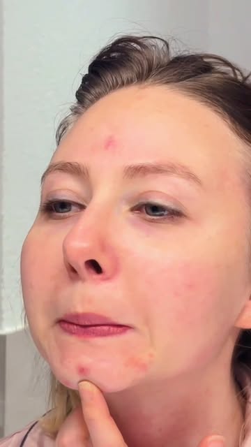 Acne Marks vs Acne Scars — क्या आपके चेहरे पर सिर्फ marks हैं या actual acne scars? 🤔

Pimples ठीक 