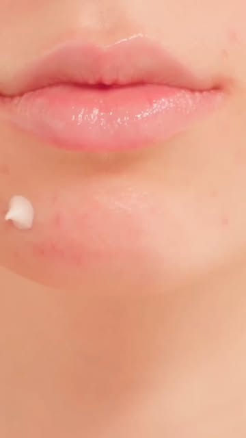 Acne Marks vs Acne Scars — क्या आपके चेहरे पर सिर्फ marks हैं या actual acne scars? 🤔

Pimples ठीक 