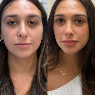 👄 From “cute” to “kiss-ready”! 💋

A little filler, a lot of confidence.

Lip filler = instant conf