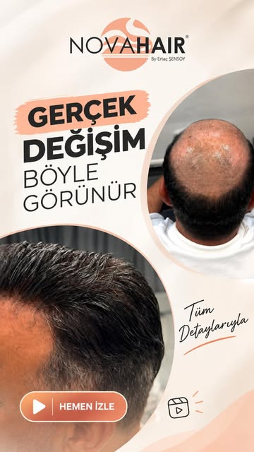 İlk görüntüdeki Nova Hair öncesi  uygulama ile işlem sonrasındaki sonucu karşılaştırdığınızda, doğru