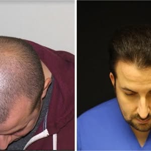 Check out these amazing results with our #Neograft procedure! Start your hair restoration journey wi