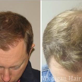 Check out these amazing #Neograft results! WHY WAIT?! Call today and start your hair restoration jou