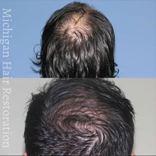 Check out these AMAZING #Neograft results! We love the results we get from this amazing procedure - 