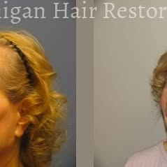 Check out these amazing results from our #Neograft procedure! Book your consultation today to get st