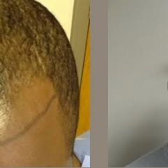 Before you start on your hair restoration journey, we want you to be informed and comfortable with t