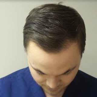 We want you to get the best idea of what your hair restoration journey will be like, one of our pati