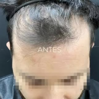Implante directo de pelo de altísima densidad en CANVASSKIN Clínica.

Recuerda: la zona donante no e