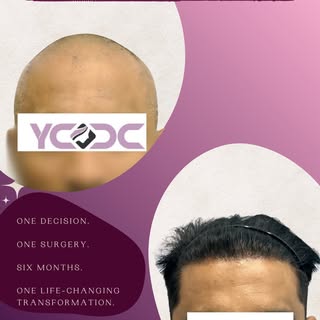 Swipe through to see the transformation →
A great hair transplant isn’t just about restoring hair — 