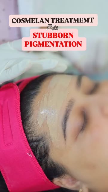 ✨COSMELAN TREATMENT FOR PIGMENTATION ✨
.
.
.
.
#skinpigmentation #skinglow #dermatologist #drvennela