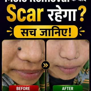✨ Thinking about Mole Removal in Bhopal? Here's what you should know!

Not every mole is the same, a