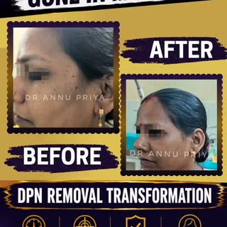 ✨ Tiny brown or black bumps on your face, neck, or under the eyes? They may be Dermatosis Papulosa N