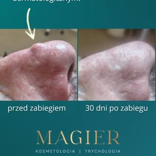 Zabieg polega na precyzyjnym odparowaniu (sublimacji) zmienionej tkanki bez naruszania głębokich war