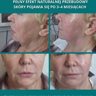 CFU to nowoczesny zabieg, który pobudza skórę do naturalnej regeneracji i produkcji kolagenu.
Skóra 