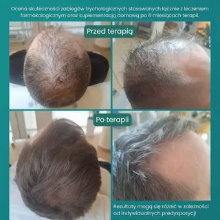 Takie efekty to wynik właściwej diagnozy, indywidualnie dobranej terapii, współpracy trychologa z le