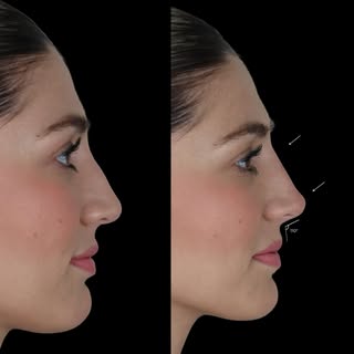 𝗥𝗶𝗻𝗼𝗺𝗼𝗱𝗲𝗹𝗮𝗰𝗶ó𝗻 con ácido hialurónico 💉

Corrección estratégica del perfil nasal para m