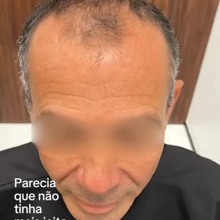 Ele achava que não tinha mais jeito. Calvície extensa, entradas bem marcadas e a autoestima lá embai