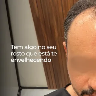 Muita gente acha que o envelhecimento começa pelas rugas.

Mas, na prática, a perda de cabelo costum